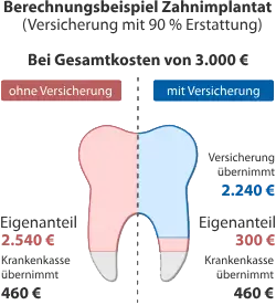 Kosten eines Implantats mit und ohne Zusatzversicherung