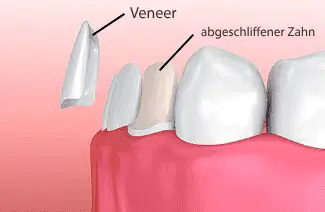 Veneers - Infografik